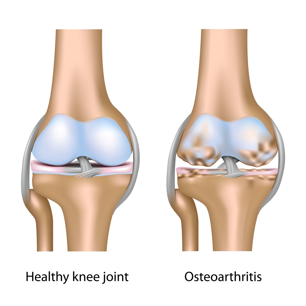 Knee arthritis