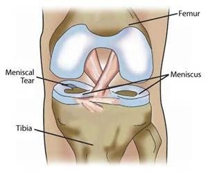 Meniscus image with tear
